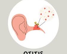 Understanding Otitis Media: Causes, Symptoms, and Treatments Understanding Otitis Media: Causes, Symptoms, and Treatments